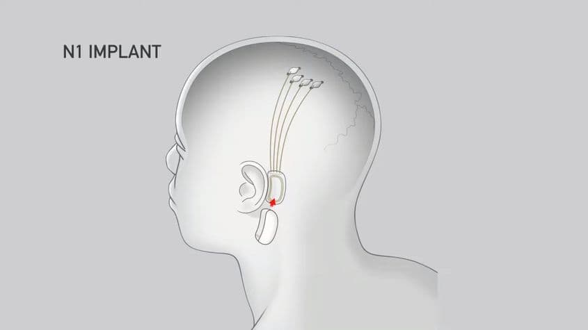 Procedura medicală va fi la fel de deranjantă precum un implant dentar