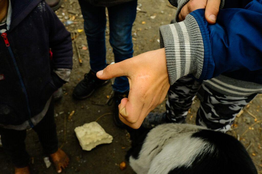 Mușcătură de câine cicatrizată. Foto: Vlăduț Bîlea