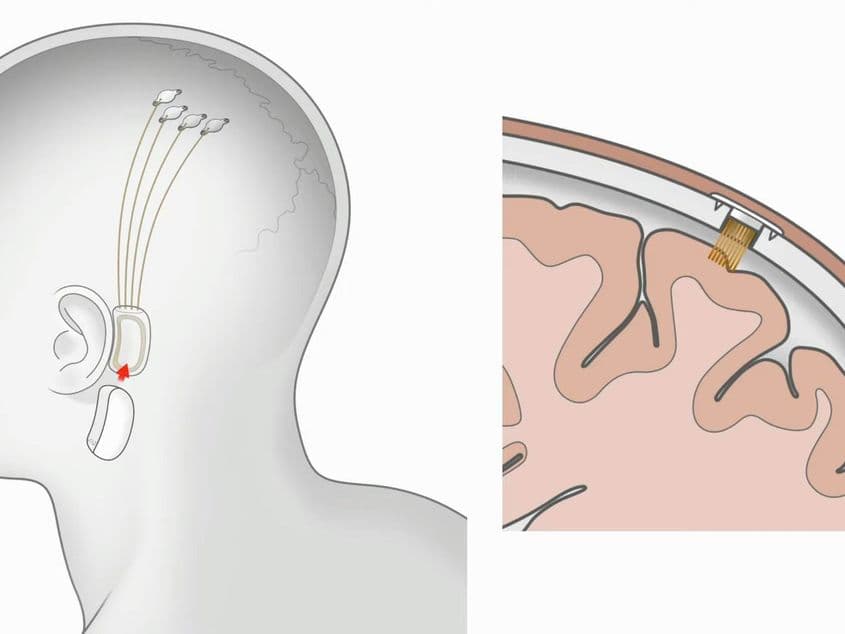 Un implant creier-computer ar putea ajuta persoanele cu dizabilități, dar apoi ar transforma complet și specia umană