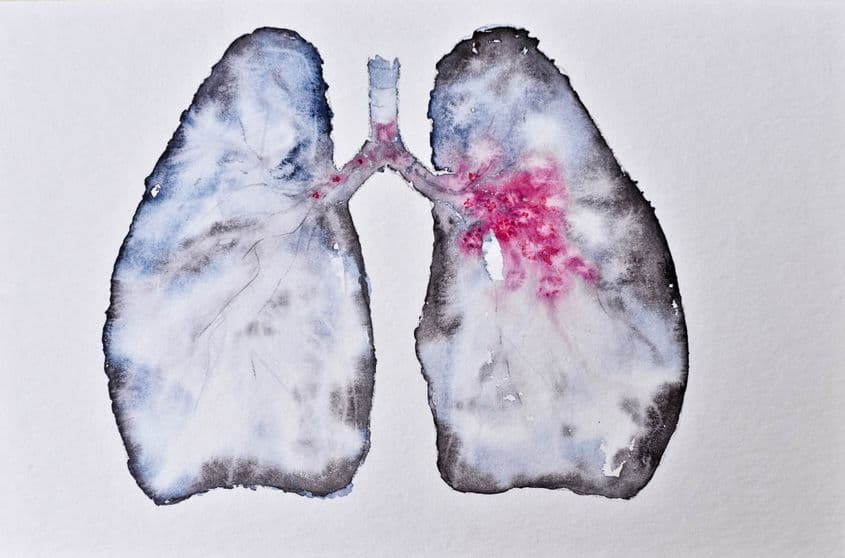 Cancer pulmonar. Ilustrație de Lucian Muntean.