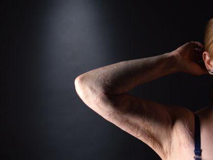 Colectiv e pe viață. Supraviețuitoare: „În 5 ani, am trecut prin 19 intervenții chirurgicale”