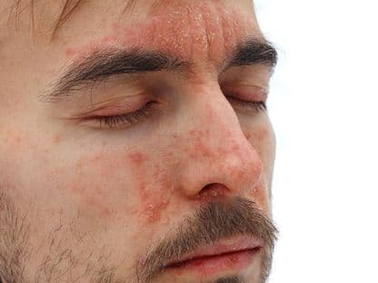 Cum e să fii pacient cu psoriazis în România: „Când oamenii văd că ai ceva pe piele se gândesc că e contagios”