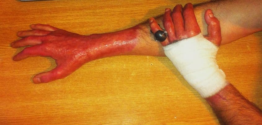 Mâinile lui Cătălin Scânteie, rănit în Colectiv, fotografiate la câteva săptămâni după incendiu.