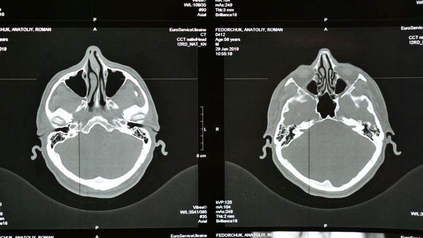 În România, accidentul vascular cerebral reprezintă a doua cauză de mortalitate, după bolile cardiovasculare. foto: ID 268755770 | Brain Stroke © Oksana Fedorchuk | Dreamstime.com