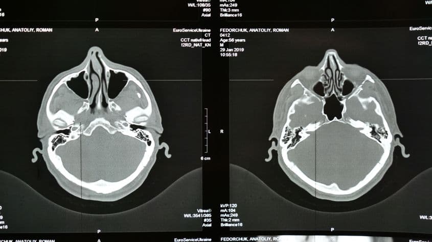 În România, accidentul vascular cerebral reprezintă a doua cauză de mortalitate, după bolile cardiovasculare. foto: ID 268755770 | Brain Stroke © Oksana Fedorchuk | Dreamstime.com